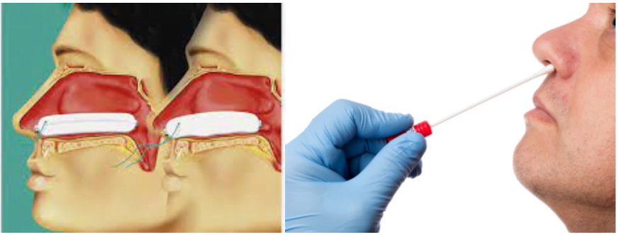 Tampão nasal e cauterização nasal