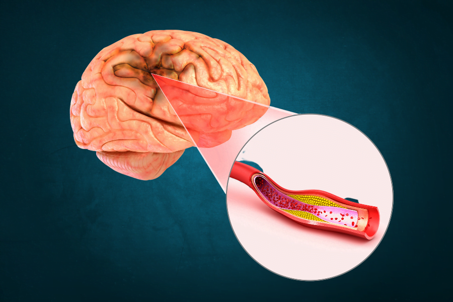 Vertigem de Origem Central