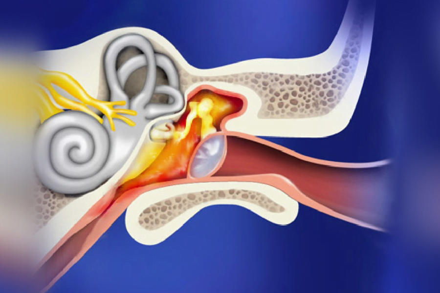 otite média secretora, com acúmulo de líquido no interior do ouvido médio