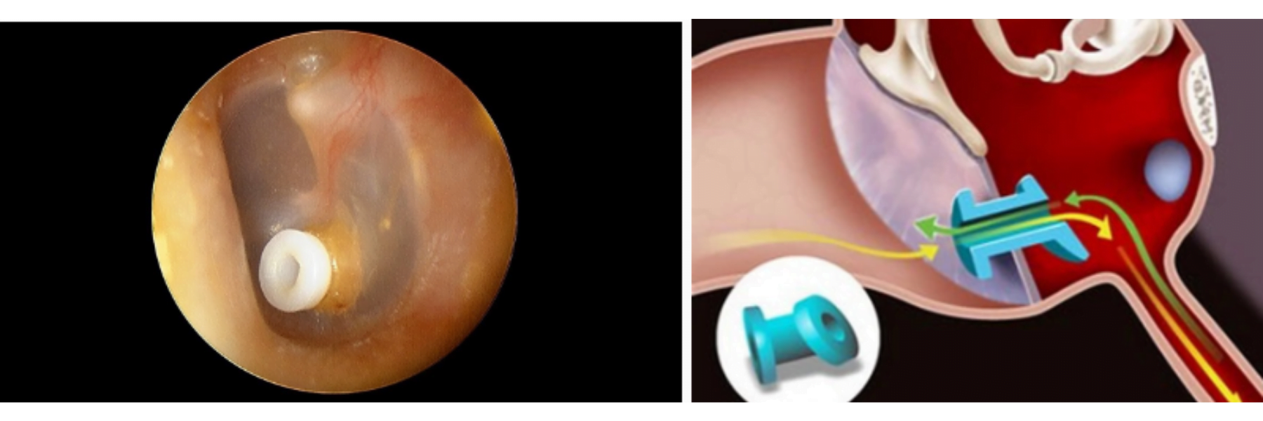 Tubo de ventilação inserido no tímpano