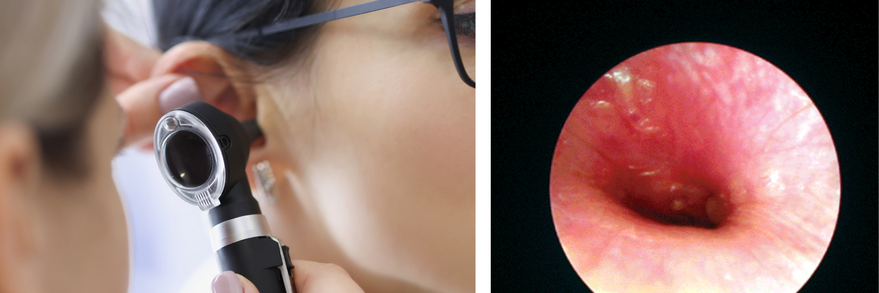 O exame com o otoscópio faz o diagnóstico da otite, visualizando o conduto auditivo vermelho e inchado