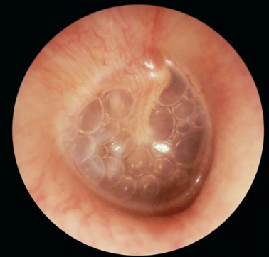 Foto de otoscopia mostrando acúmulo de líquido no ouvido médio