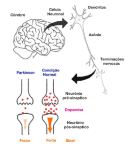 Diminuição da dopamina o uue causa , e alterações no equilíbrio na doença de Parkinson