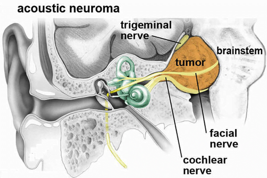 Schawnnoma vestibular