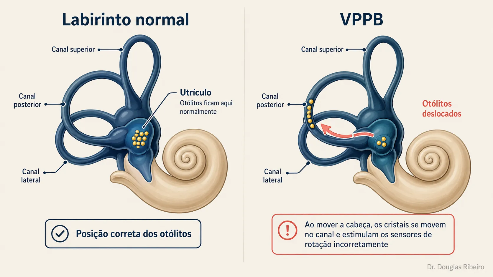 Diagrama comparativo do labirinto normal com otólitos no utrículo versus VPPB com otólitos deslocados no canal posterior