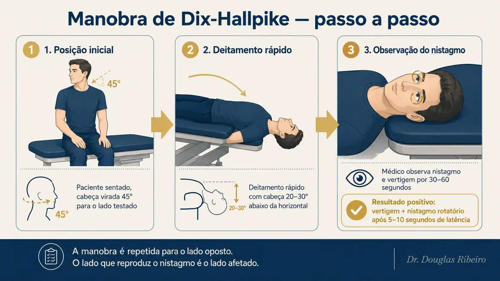 Diagrama em três etapas da manobra de Dix-Hallpike: posição inicial, deitamento com cabeça rodada e observação do nistagmo pelo médico