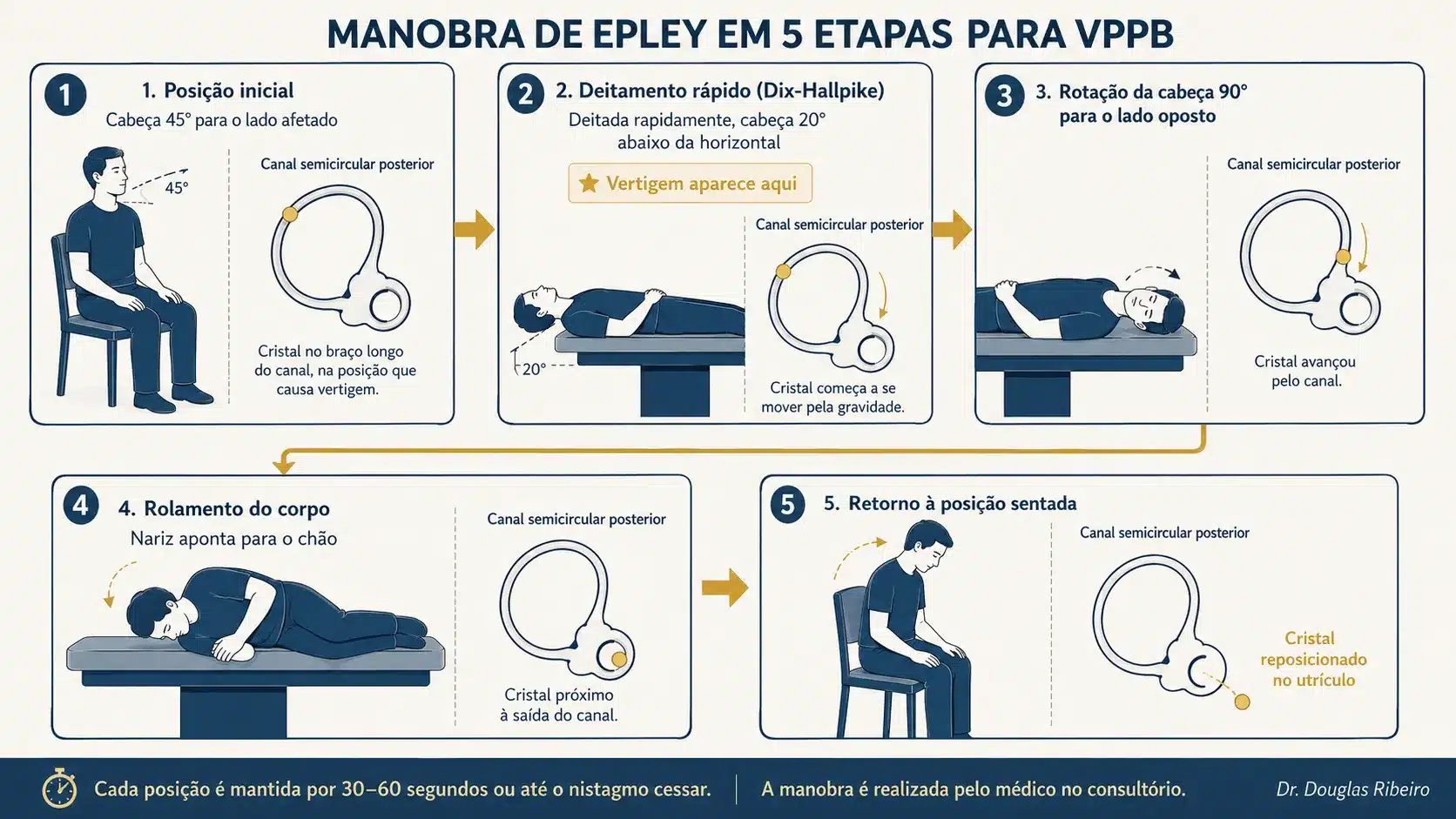 Diagrama em cinco etapas da manobra de Epley mostrando a posição do corpo e o deslocamento do cristal no canal semicircular em cada passo do tratamento