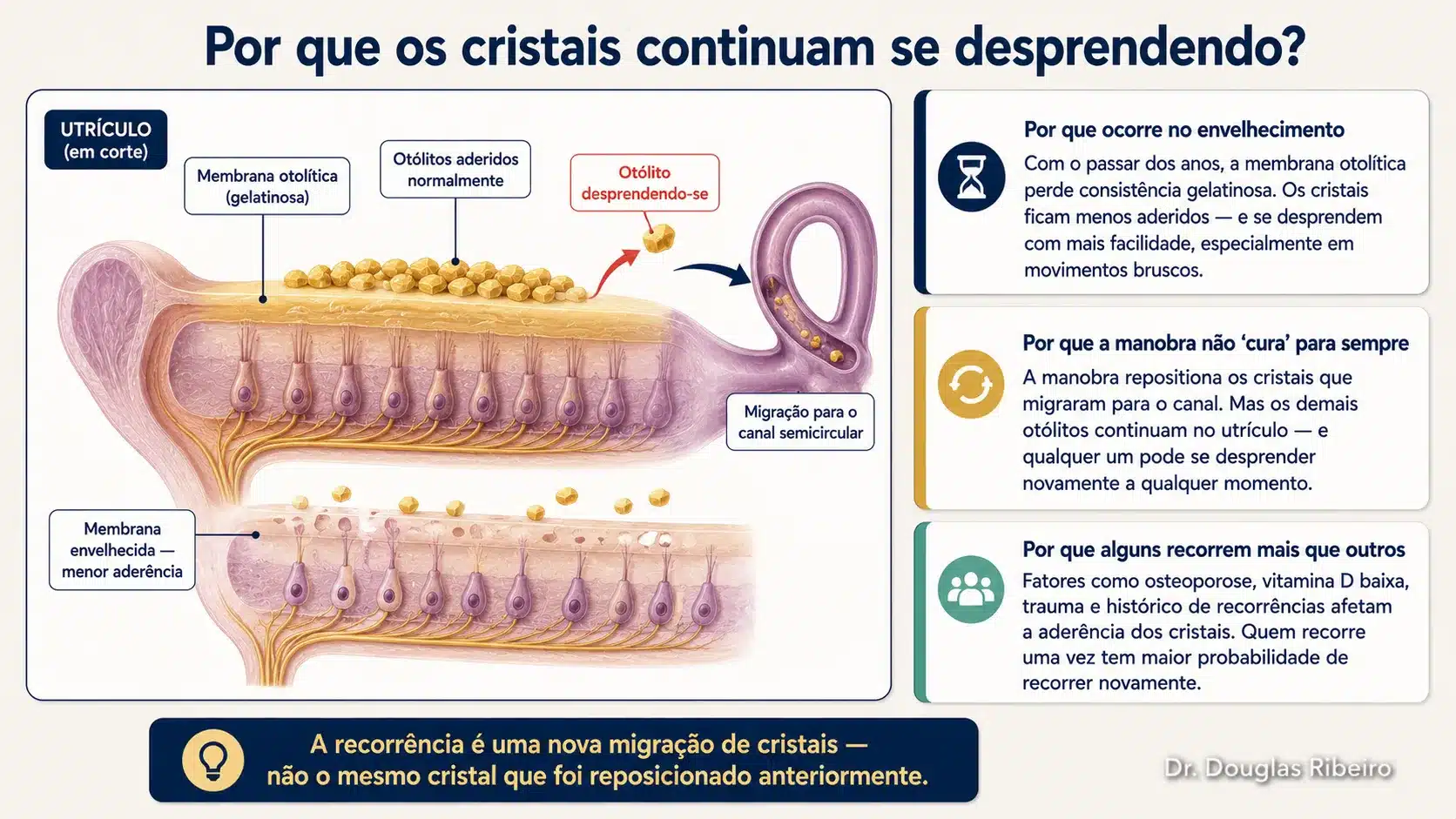 Diagrama mostrando o mecanismo de desprendimento dos otólitos do utrículo, explicando por que o VPPB pode recorrer mesmo após tratamento bem-sucedido