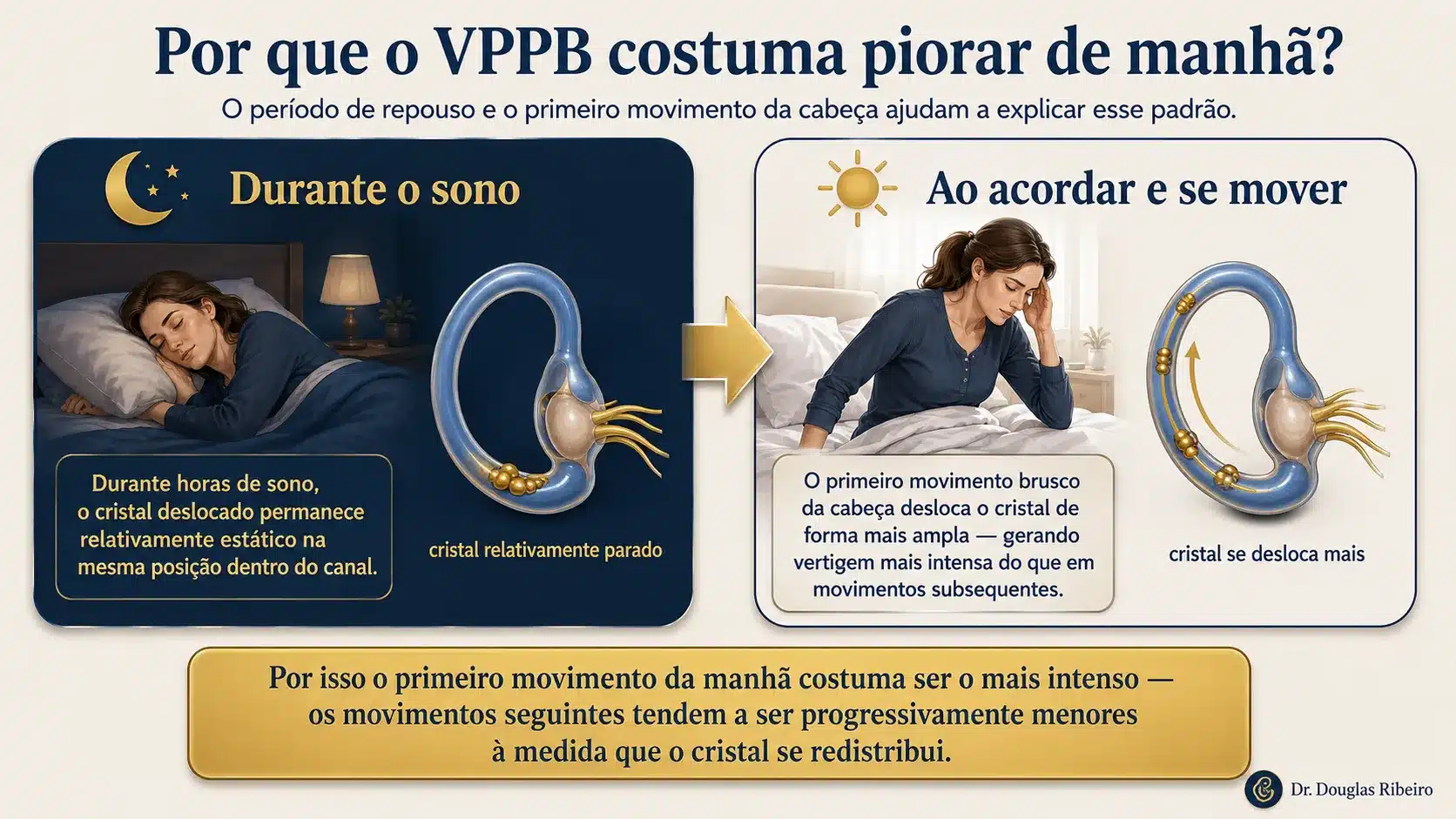 Diagrama explicando por que o VPPB costuma ser mais intenso ao acordar: o cristal estático durante o sono se desloca com maior amplitude no primeiro movimento da manhã