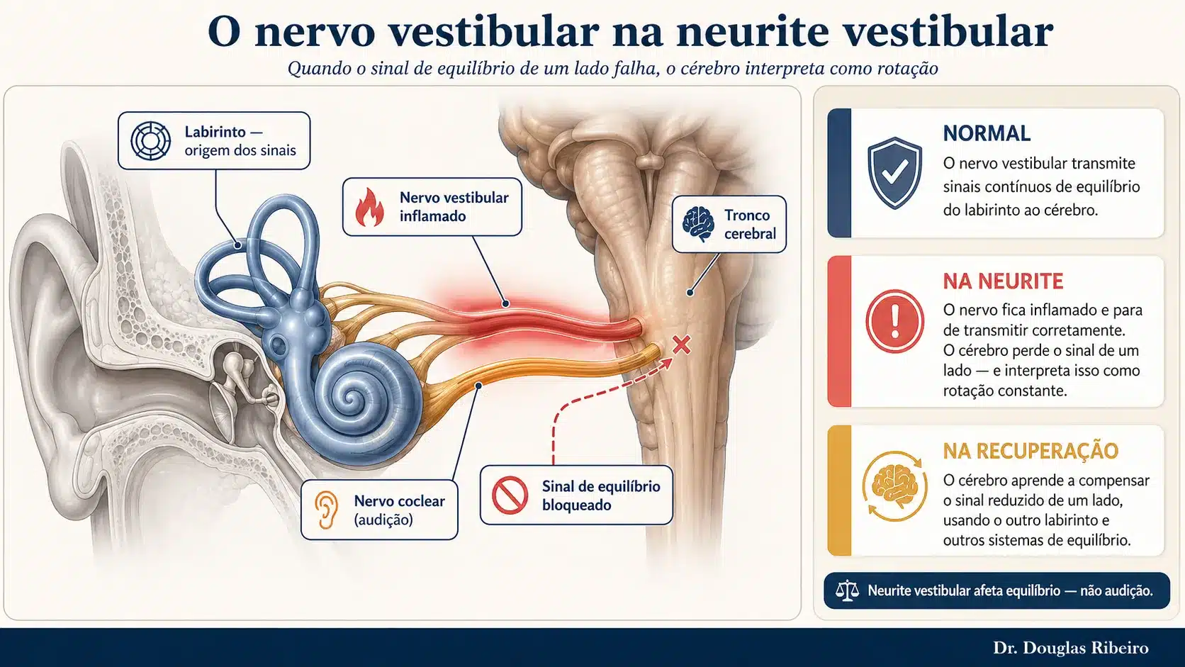 Diagrama do nervo vestibular inflamado mostrando o bloqueio do sinal de equilíbrio e os três estágios: normal, neurite e recuperação
