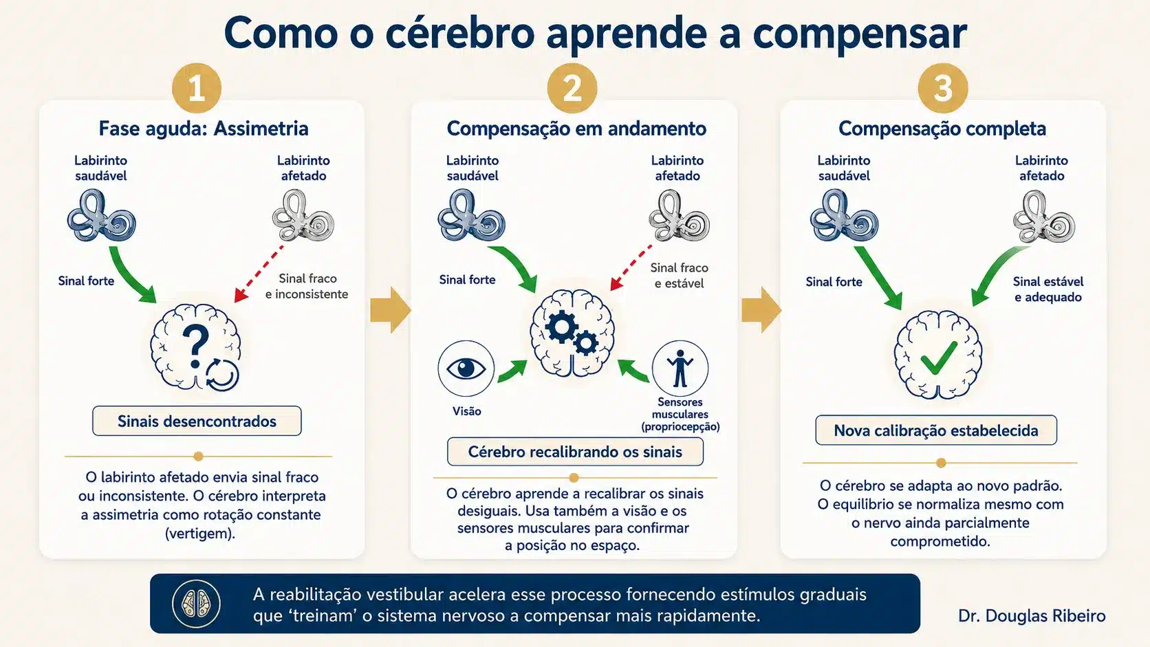 Diagrama em três etapas mostrando o processo de compensação vestibular: assimetria de sinais na fase aguda, recalibração progressiva e nova calibração estabelecida na recuperação