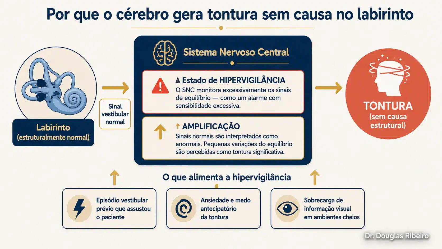 Diagrama mostrando o mecanismo da TPPP: labirinto normal enviando sinal para um sistema nervoso central em hipervigilância, que amplifica os sinais e gera tontura sem causa estrutural