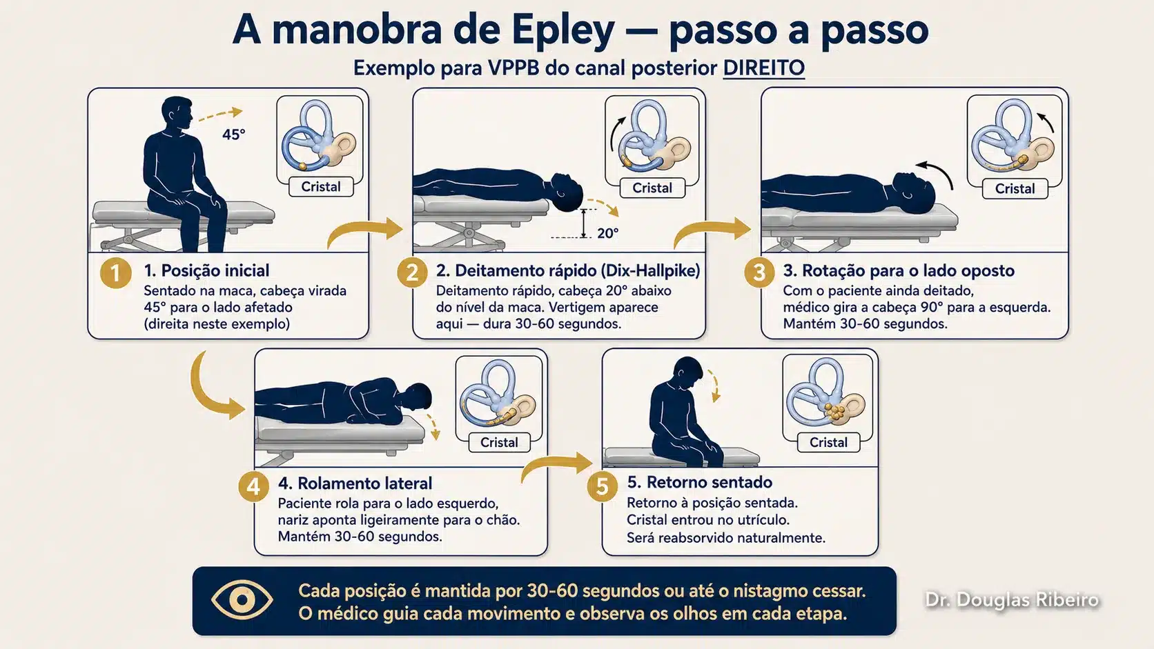 Diagrama em cinco posições da manobra de Epley mostrando a posição do corpo e o deslocamento do cristal no canal semicircular em cada etapa do procedimento