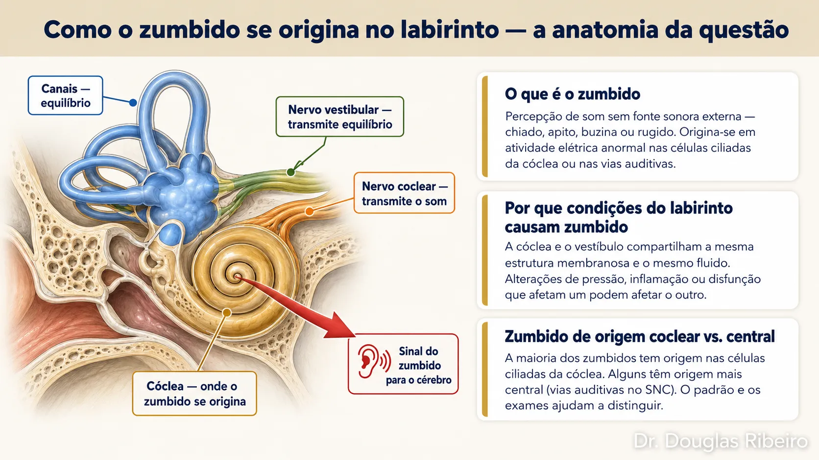 Diagrama mostrando a origem do zumbido na cóclea do labirinto, com ilustração anatômica e explicação de como condições do ouvido interno causam a percepção de sons sem fonte externa